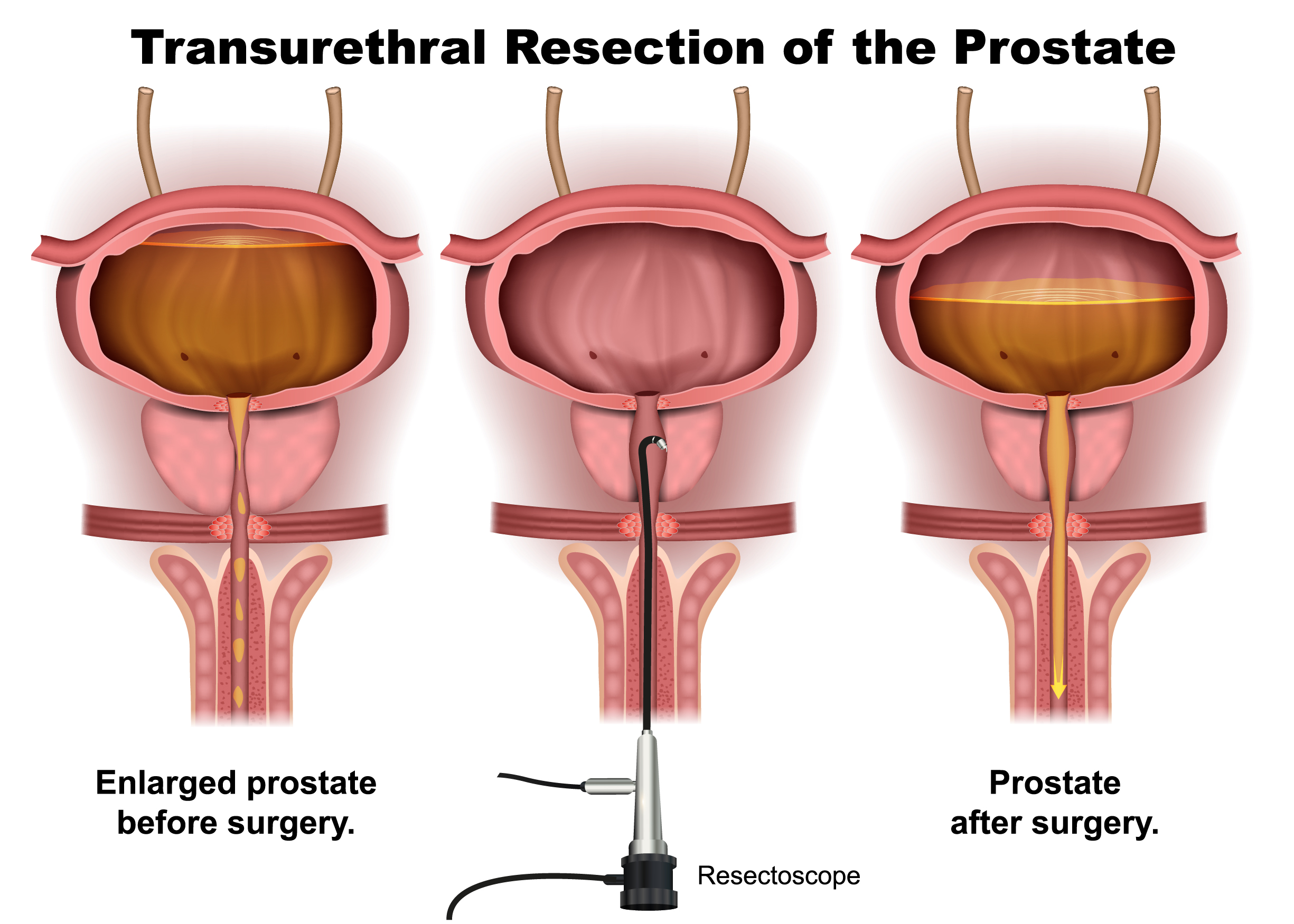 Surgeries Therapies For BPH Feifer Urology