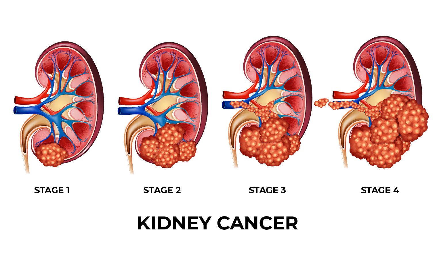 latest research on kidney cancer